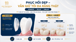 Minh họa phục hồi răng bằng Veneer, Inlay/Onlay theo hướng ít xâm lấn, giúp cải thiện thẩm mỹ và ăn nhai nhưng vẫn ưu tiên bảo tồn răng thật tại Nha Khoa Như Tâm.