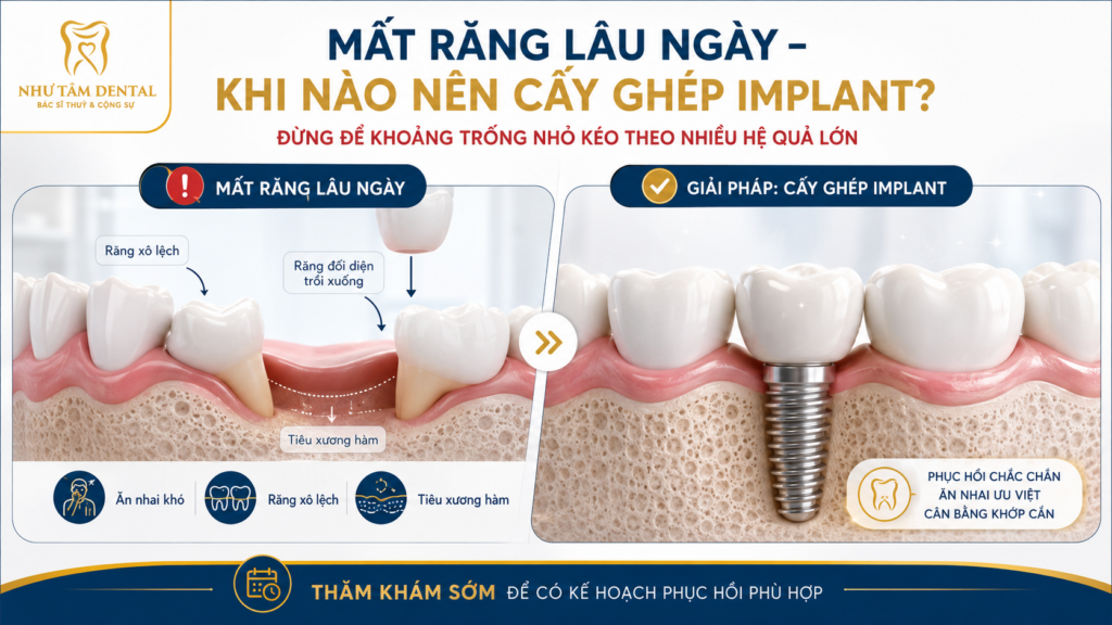 Minh họa tình trạng mất răng lâu ngày, răng bên cạnh nghiêng lệch, răng đối diện trồi xuống và giải pháp cấy ghép Implant tại Nha Khoa Như Tâm.