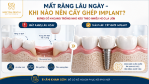Minh họa tình trạng mất răng lâu ngày, răng bên cạnh nghiêng lệch, răng đối diện trồi xuống và giải pháp cấy ghép Implant tại Nha Khoa Như Tâm.