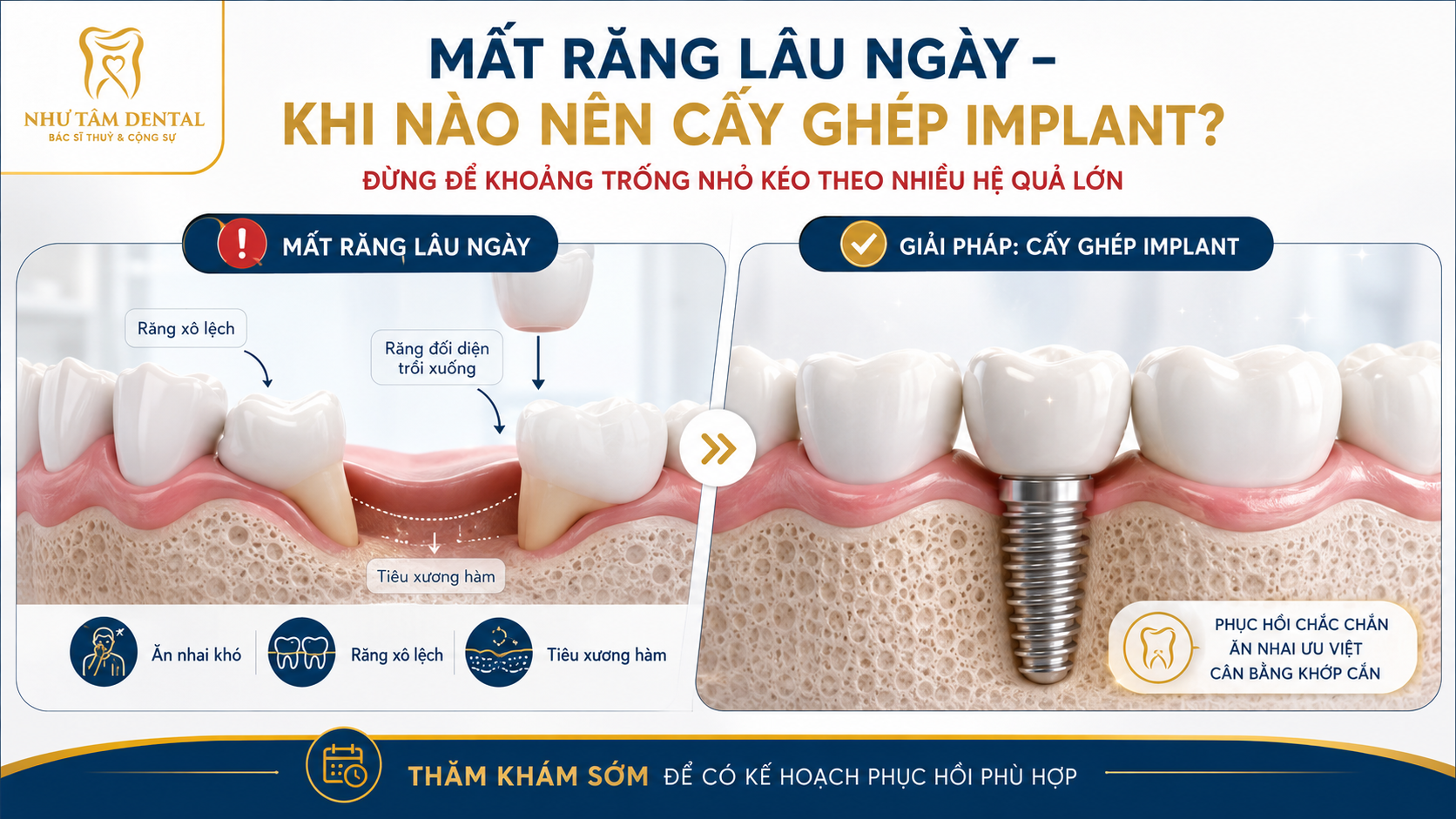 Minh họa tình trạng mất răng lâu ngày, răng bên cạnh nghiêng lệch, răng đối diện trồi xuống và giải pháp cấy ghép Implant tại Nha Khoa Như Tâm.