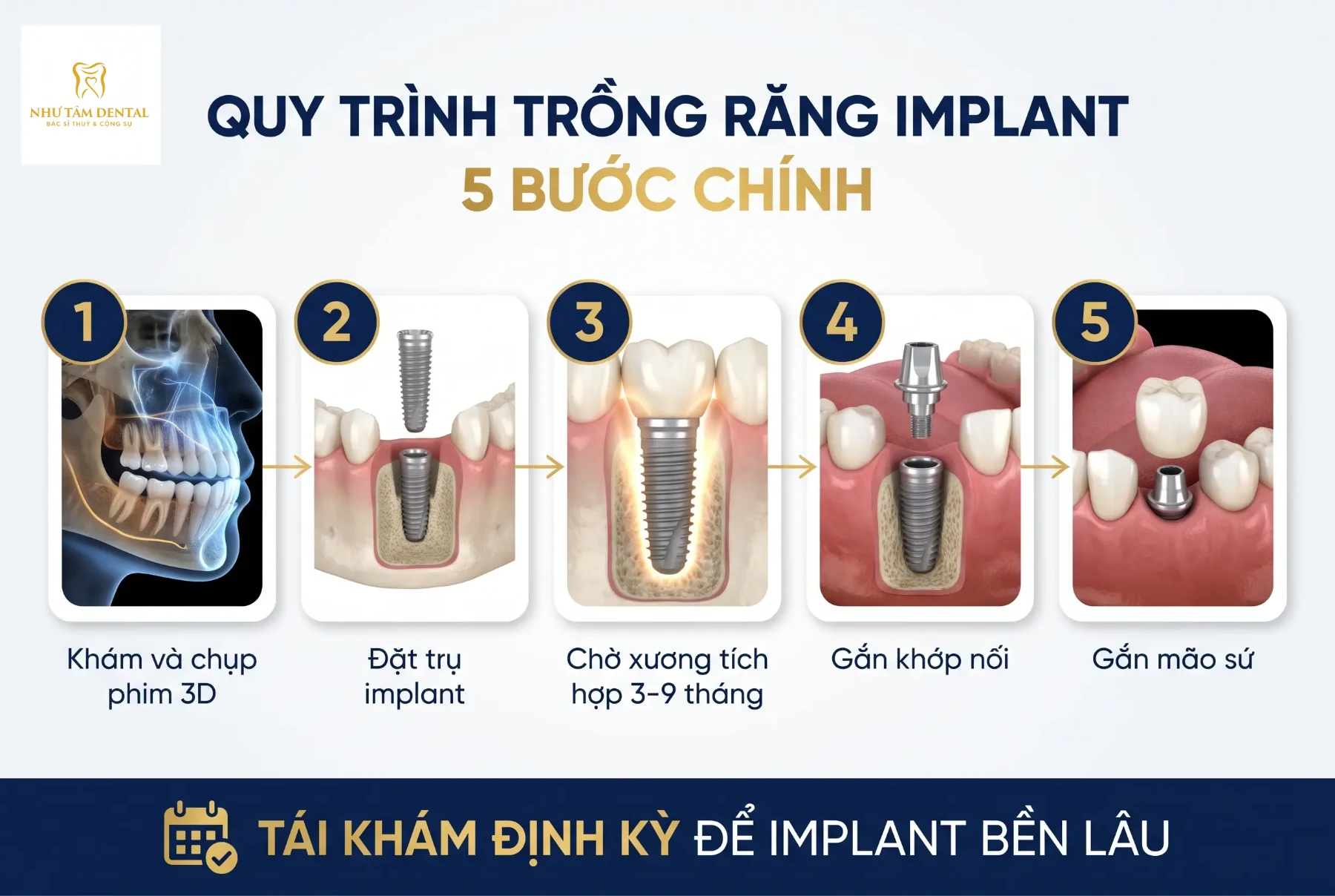 Quy trình trồng răng implant 5 bước – Nha Khoa Như Tâm