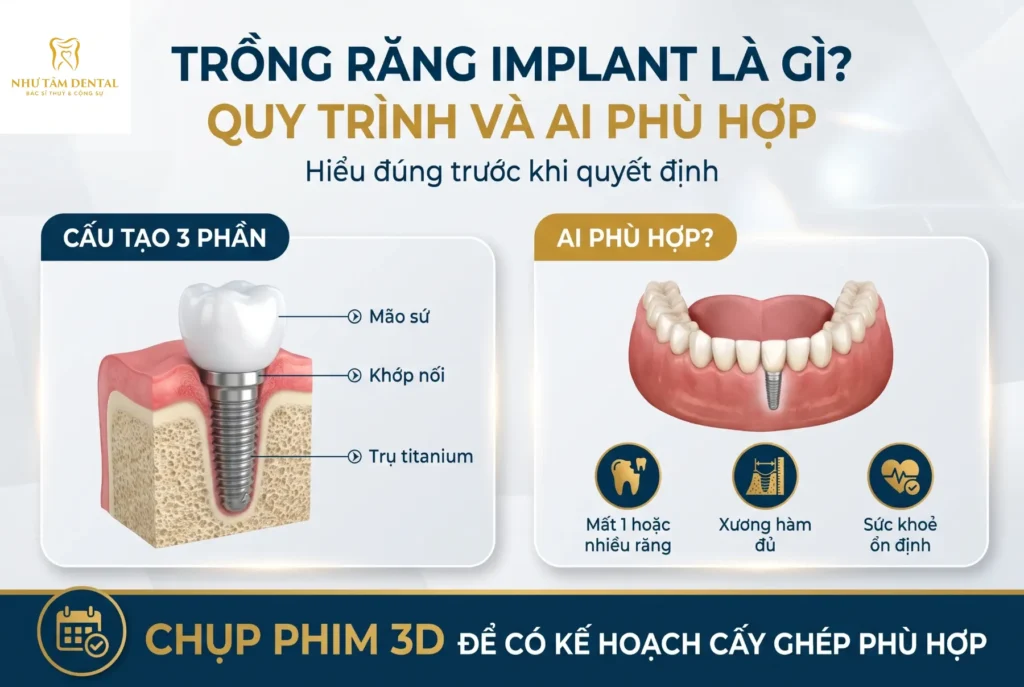 Infographic trồng răng implant: cấu tạo 3 phần gồm mão sứ, khớp nối, trụ titanium và những ai phù hợp – Nha Khoa Như Tâm